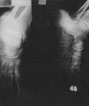 Xray