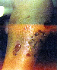 Arm wound image 1