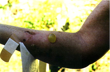 Arm wound image 2