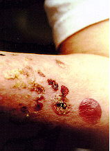Arm wound image 3